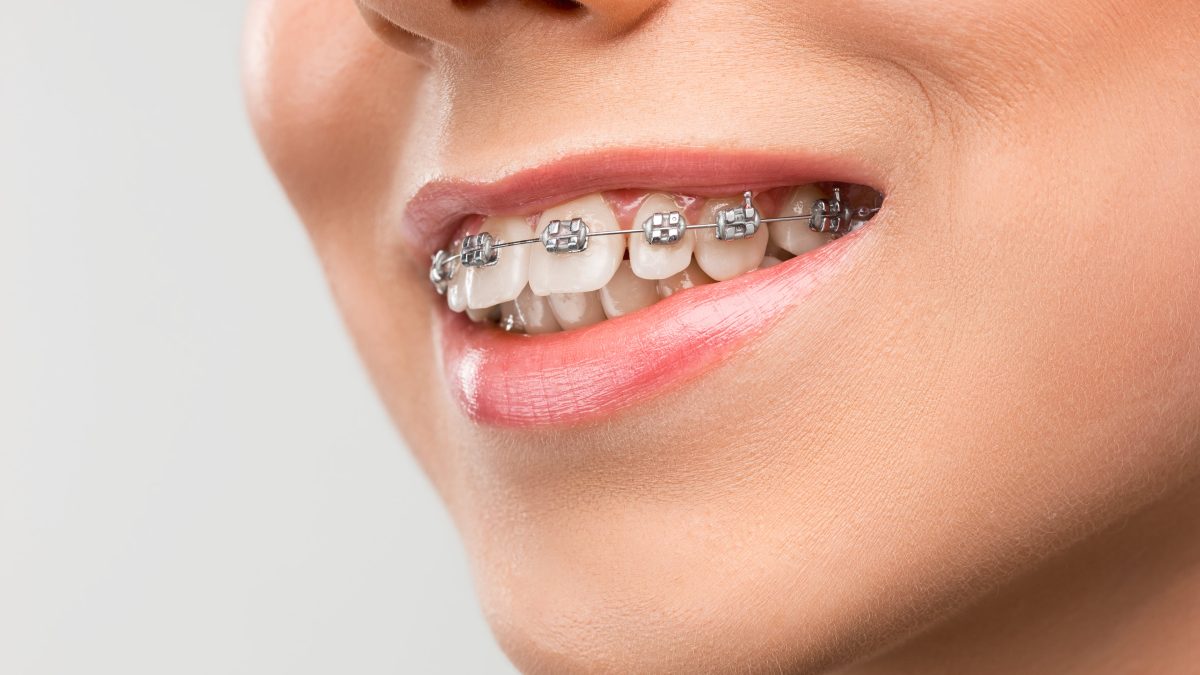 Dental Braces