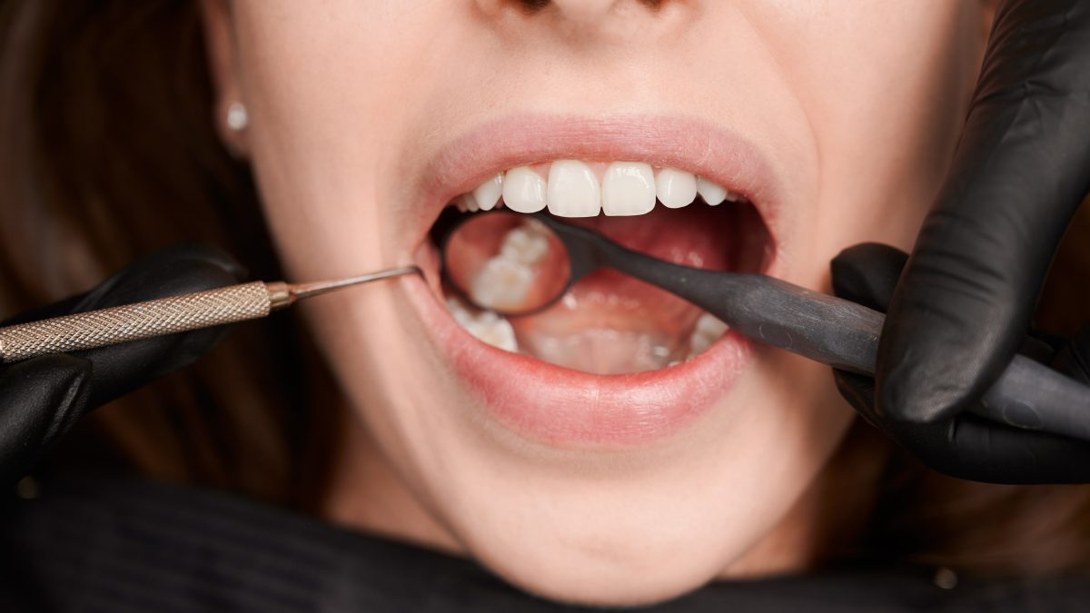 dental crowns
