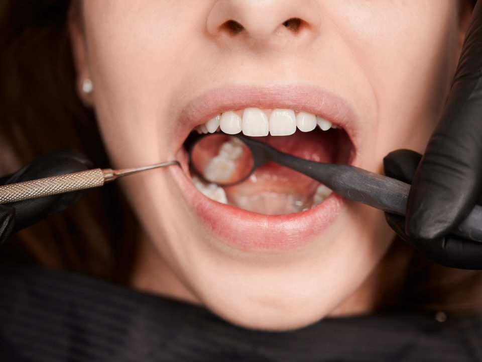 dental crowns